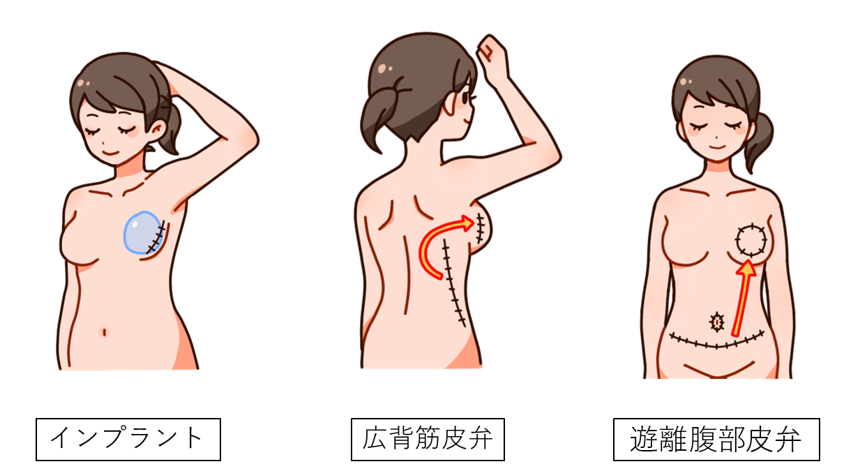 乳房再建方法：①インプラント、②広背筋皮弁、③遊離腹部皮弁