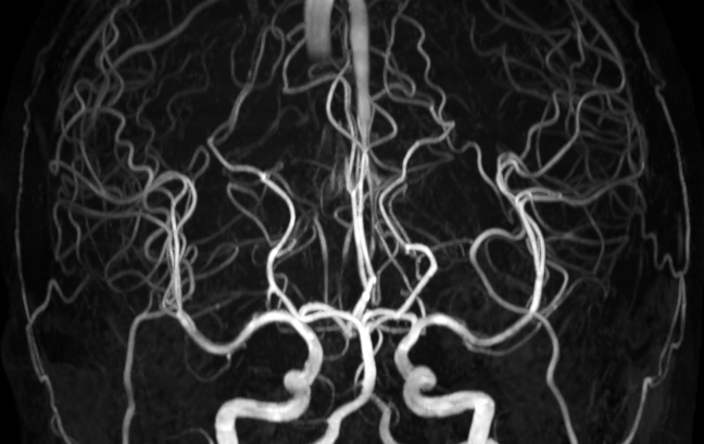 脳のMRアンギオグラフィティ