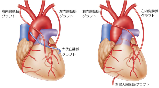 両側内胸動脈グラフト