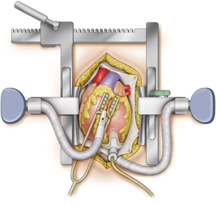 冠動脈バイパス手術イメージ